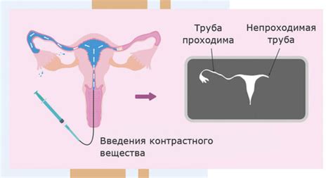 Маточные трубы: важность проходимости