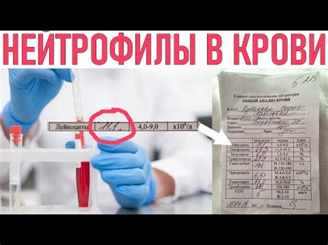 Медицинское значение уровня нейтрофилов