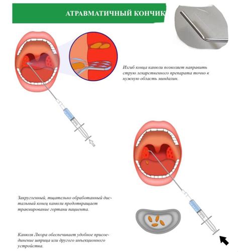 Методика промывания горла