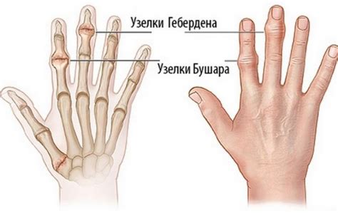 Методы диагностики узелков Гебердена