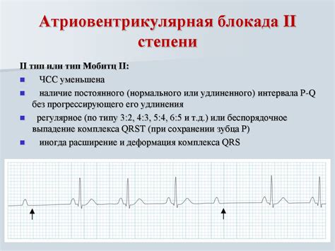 Методы лечения блокады 2 степени и 2 типа