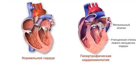 Методы лечения и профилактика гипертрофии