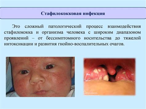 Методы лечения стафилококковой инфекции в носу: эффективные стратегии и рекомендации