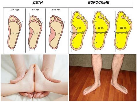 Методы улучшения плоскостопия