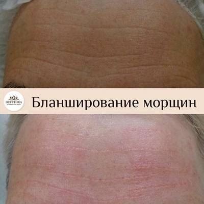 Методы устранения складок