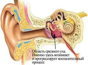 Механизмы развития воспаления среднего уха