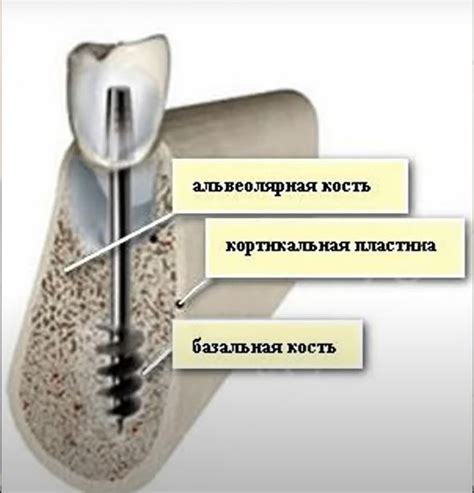 Минусы замены штифта