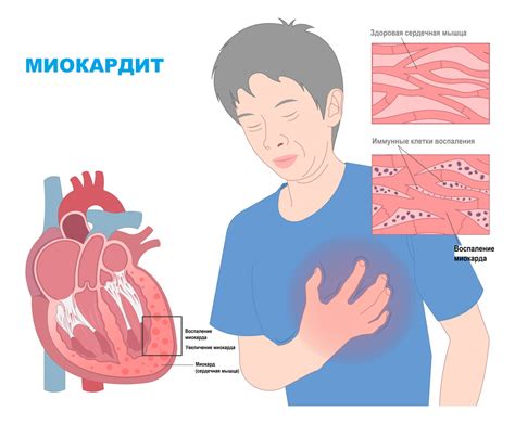 Миокардит