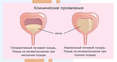 Мочевой пузырь и боль: взаимосвязь и причины