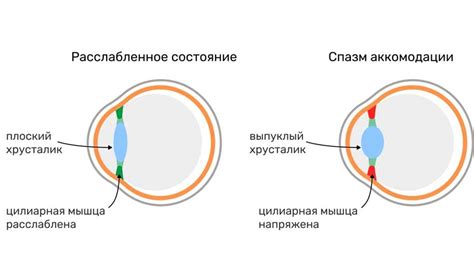 Нарушение аккомодации глаз у детей