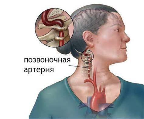 Нарушение венозного оттока при шейном остеохондрозе