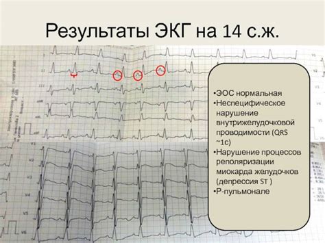 Нарушение внутрижелудочковой проводимости на электрокардиограмме