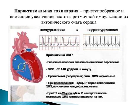 Нарушение предсердной проводимости на ЭКГ