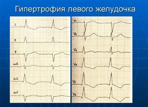 Нарушение реполяризации миокарда левого желудочка