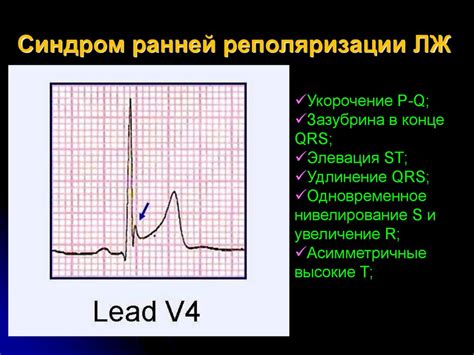 Нарушение фазы реполяризации