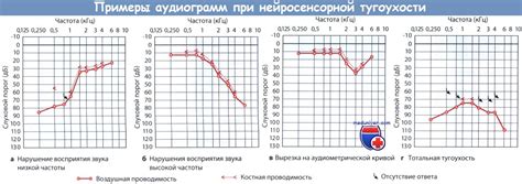 Нарушения восприятия звука