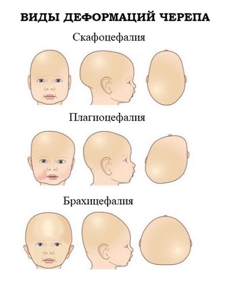 Наследственность, деформация черепа, внешние воздействия