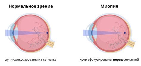 Натуральные способы предотвращения прогрессирования миопии