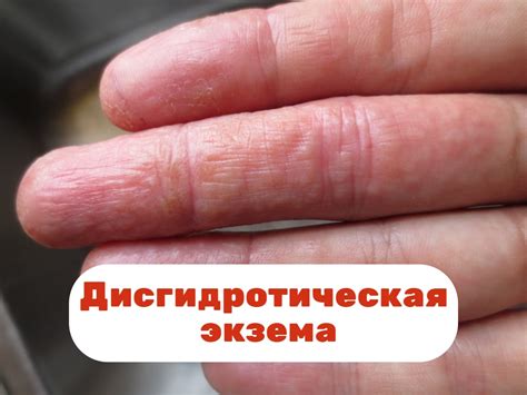 На пальцах шишки: основные причины и симптомы