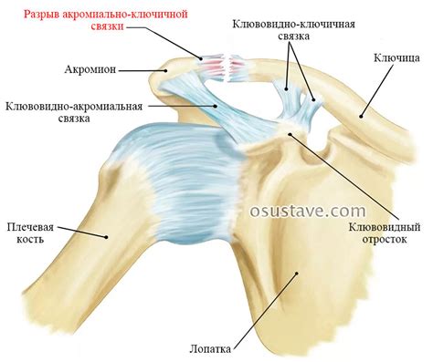 Немедленные действия в случае повреждения связок плечевого сустава