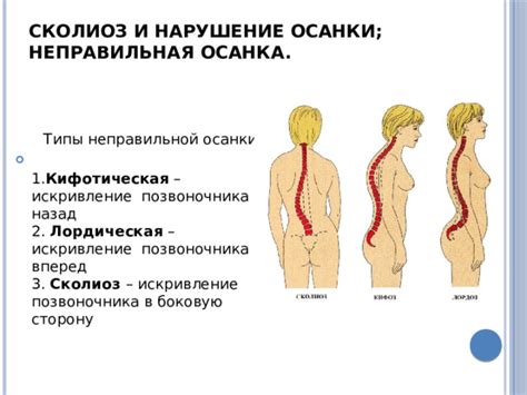 Неправильная осанка и сколиоз