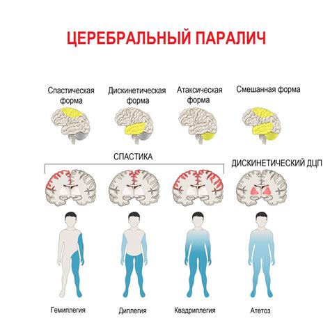 Нервные заболевания и паралич