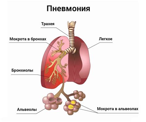 ОРВИ и пневмония у взрослых