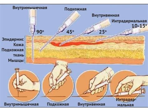 Обработка места инъекции