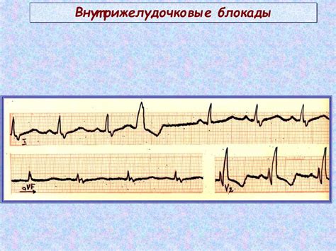 Общая информация о внутрижелудочковой проводимости