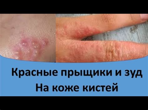 Оказываем помощь при возникновении водянистых прыщей на руках