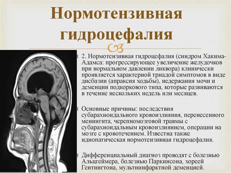 Определение и симптомы внутренней заместительной гидроцефалии