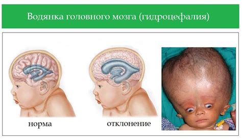 Определение и симптомы наружной заместительной гидроцефалии