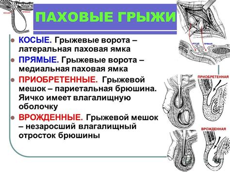 Определение паховой грыжи у мужчин