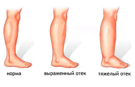 Определение причины отечности ног