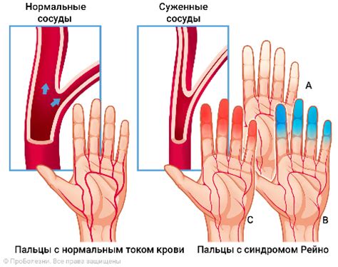 Оптимальная доза кофе при синдроме Рейно