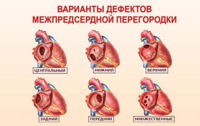 Осложнения и последствия нарушения межпредсердной проводимости