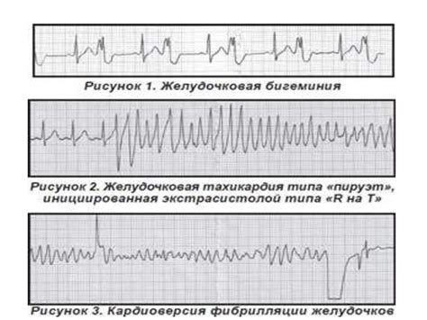 Осложнения нарушения проводимости