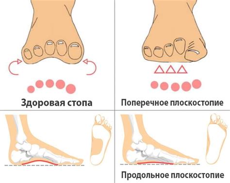 Основные виды вкладок для коррекции плоскостопия у взрослых