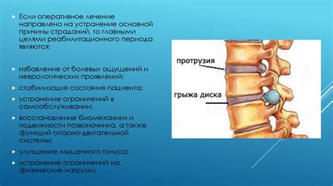 Основные принципы физической реабилитации после удаления межпозвоночного диска