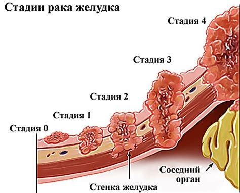 Особенности метода приклеивания бинтов на область желудка