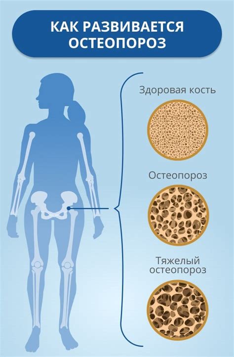 Остеопороз и заболевания костей