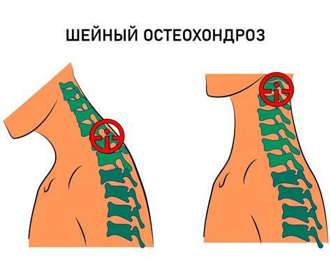 Остеохондроз шейного отдела