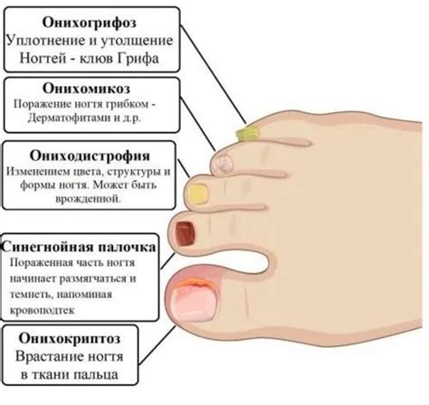 Первая помощь для сорванного ногтя на ноге