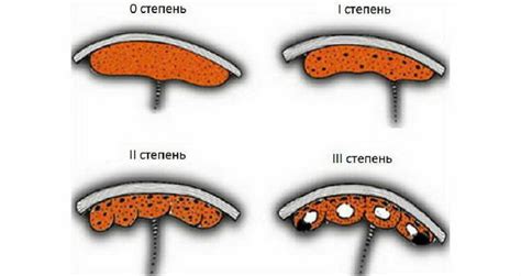 Плацента степени зрелости 2