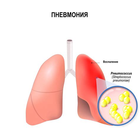 Пневмококковая инфекция и ее последствия