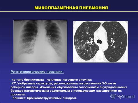 Пневмония и другие инфекционные заболевания