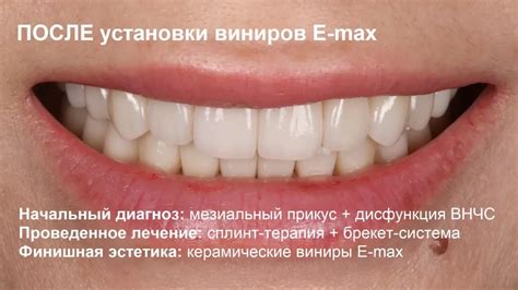 Подготовка к установке виниров Smile