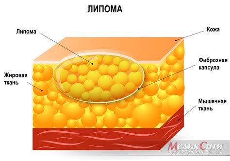 Подкожная жировая киста или липома