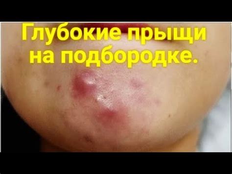 Половые гормоны и связь с прыщами на подбородке