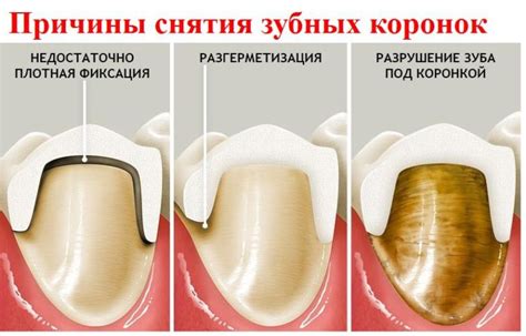 Полоскание нарытых зубов под коронкой